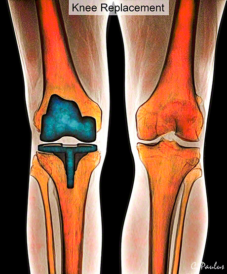 МРТ колена после травмы